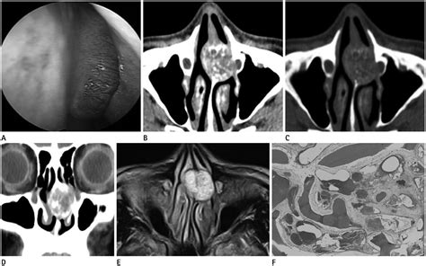 Intraosseous Hemangioma Of The Nasal Septum A Case Report