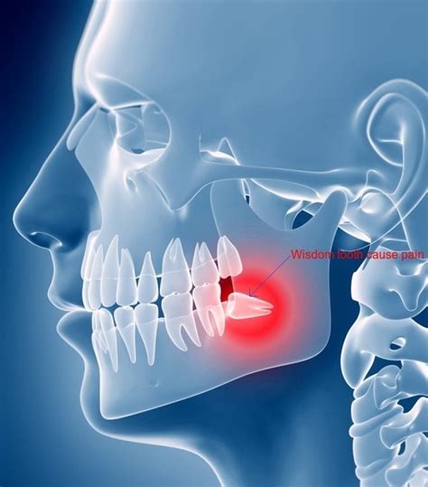Impacted Tooth Sign Symptoms Treatments Know In Details