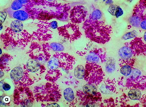 Grand Round Mycobacterium Paratuberculosis Cervical Lymphadenitis