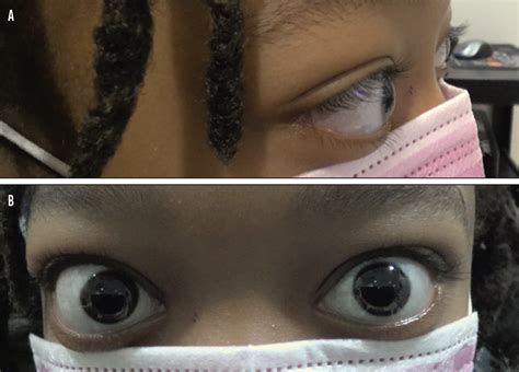 Rare Anterior Segment Diseases In Children Modern Optometry