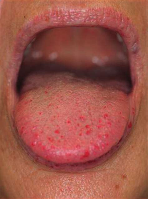 Painless Red Spot On Tongue