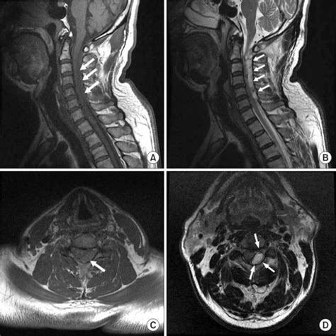Magnetic Resonance Images Of Cervical Spine A T1 Weighted Sagittal