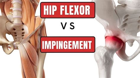 Get The Right Diagnosis Fai Impingement Or Hip Flexor Strain Youtube