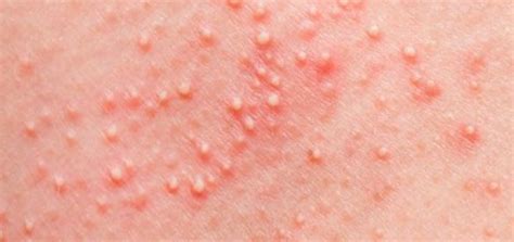 Occasionally a mosquito bite causes a large area of swelling, soreness and redness. Rash with small white bumps that itch | Allergy skin rash