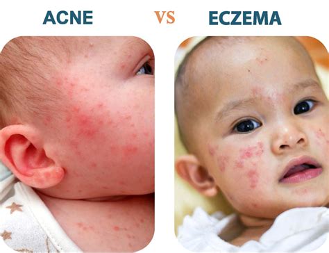 Baby Acne Vs Eczema Understanding The Difference