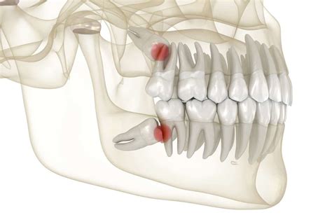 Learn What Will Happen If Wisdom Teeth Are Not Removed Absolute Dental