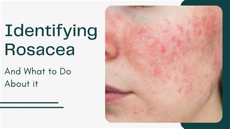 Identifying Rosacea And What To Do About It Winston Salem Dermatology