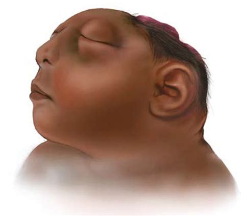 Facts About Anencephaly Cdc