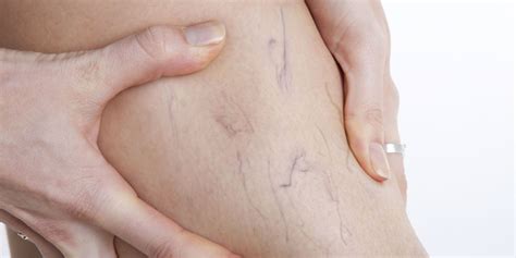 The Dangers Of Leaving Varicose Veins Untreated Huffpost