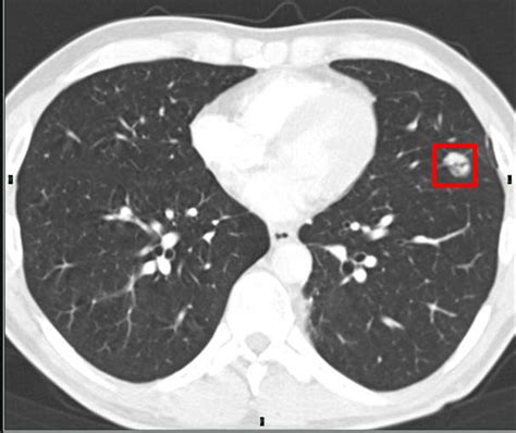 How To Interpret Ct Scans Of Your Lung
