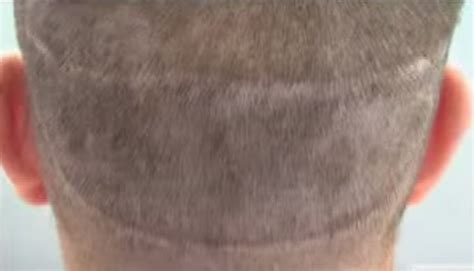 Hair Transplant Repair Getting Rid Of A Strip Scar After Fut