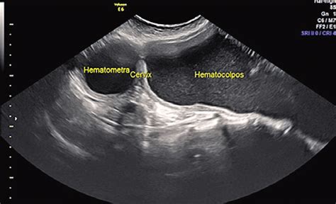 Ultrasound Scan Showing The Fluid In The Vagina Hematocolpos And My