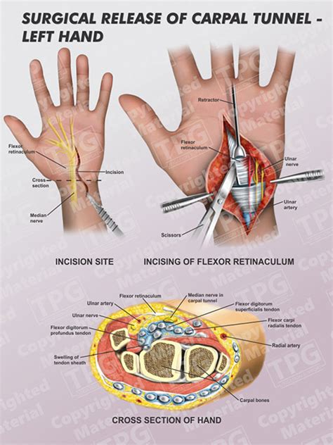 Surgical Release Of Carpal Tunnel Left Order