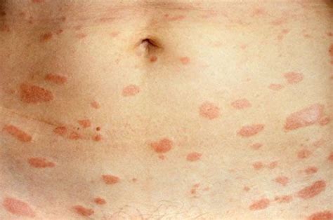 13 Causes Of Red Spots On Skin