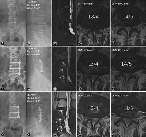 Ll And Sl Siginfiacntly Improved From Preoperative Ab To 1 Day