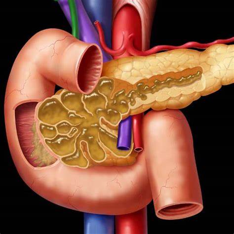 Pancreatic IPMN | Radiology Key Картинка - Pancreatic IPMN | Radiology Key