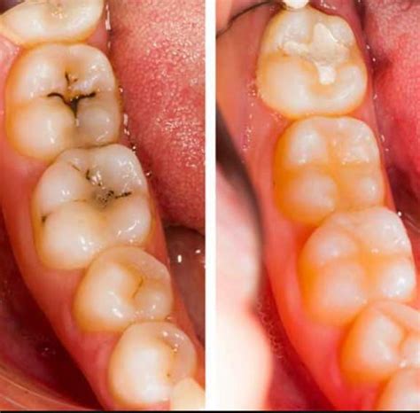 Cavities Fillings Dental Pain