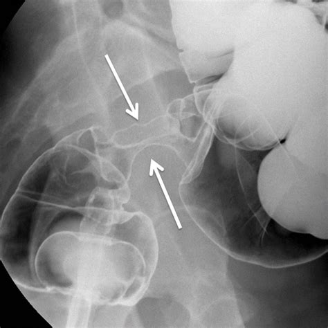 Contrast Enema Examination Technique And Essential Findings