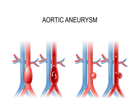 Recommendations For Abdominal Aortic Aneurysm Screening Aapc
