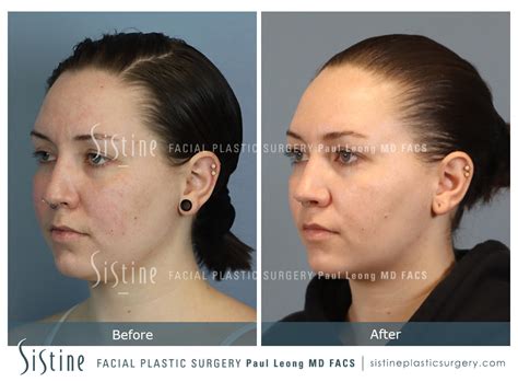 Buccal Fat Removal Before And After 01 Sistine Facial Plastic Surgery