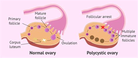 What Is Pcos Or Polycystic Ovary Syndrome