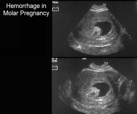 How Early Can A Molar Pregnancy Be Detected By Ultrasound Pregnancywalls