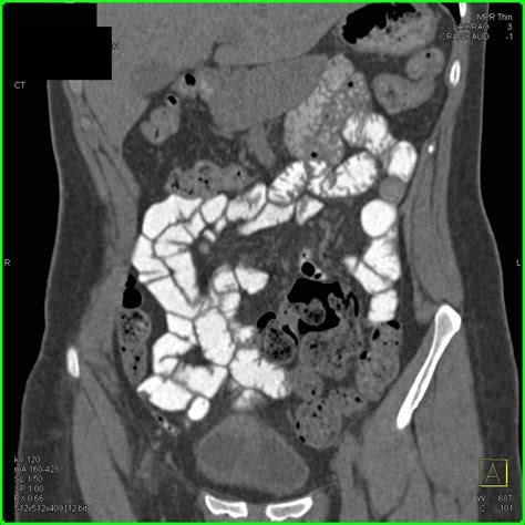 Normal Small Bowel With Positive Contrast Small Bowel Case Studies