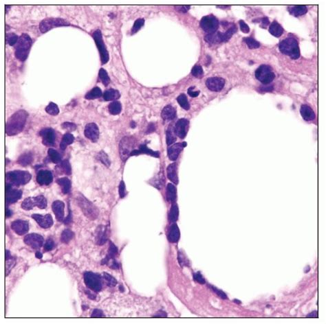 Subcutaneous Panniculitis Like T Cell Lymphoma Basicmedical Key