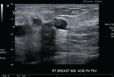 Acquired Arteriovenous Fistula Of The Breast Following Ultrasound