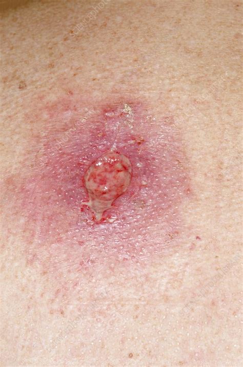 Infection After Skin Cancer Removal Stock Image C0130844 Science