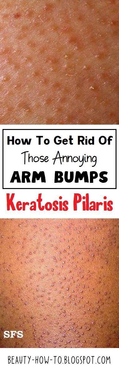 How To Get Rid Of Those Annoying Arm Bumps Keratosis Pilaris