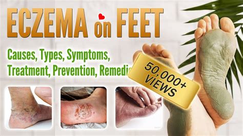 Eczema On Feet Causes Symptoms Types Treatment Prevention And Home