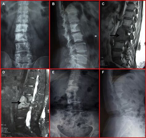 Surgical Treatment Of A Sebaceous Cyst In The Spine Region The Spine