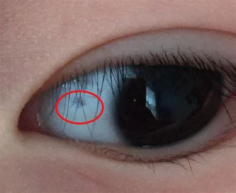 Why Do Children Have Black Spots In Their White Eyes Mostly Caused