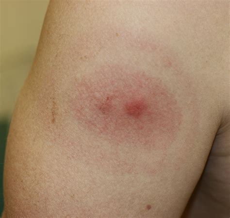 Lymes Disease The Classic Bullseye The Spot Of The Tick Flickr