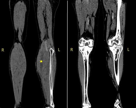 Lower Extremity Ct Scan With Intravenous Contrast Signs Of