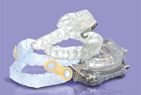 Oral Appliance Therapy For Obstructive Sleep Apnea Sleep Doctors Ft Myers Bonita Springs