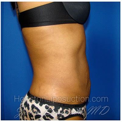 Patient Liposuction Before And After Photos Katy Cosmetic Surgery Gallery Houston Tx