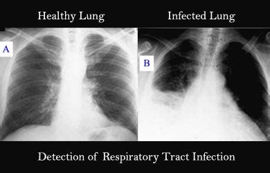 Get more information on small cell lung cancer lung cancer deaths account for a quarter of all american cancer deaths, killing more people every year than prostate, breast, and colon cancer. Chest Radiography | Chest X-ray Radiography