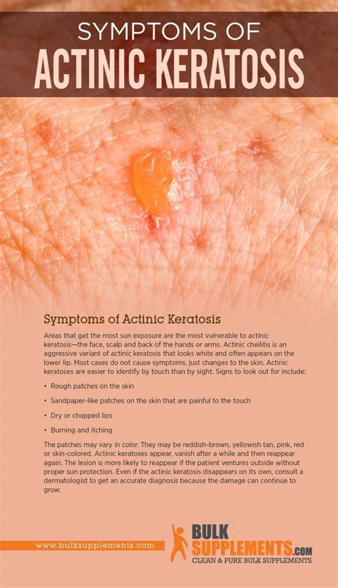 Everything You Need To Know About Painful Actinic Keratosis