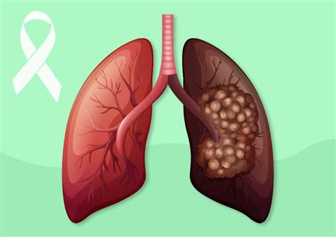 Lung Cancer Awareness Symptoms Stages And Treatment Mhospital