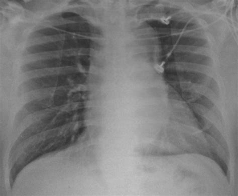 Aortic Dissection Radiology Aortic Dissection