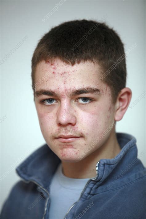 Teenage Boy With Acne Stock Image C0495013 Science Photo Library