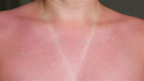 Young Woman Bare Sunburned Red Chest And Neck Closeup Stock Photo