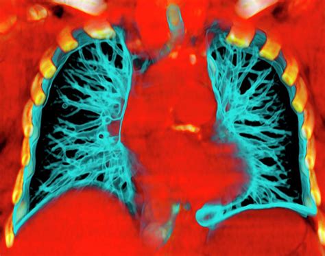 Healthy Lungs Photograph By Du Cane Medical Imaging Ltd Pixels