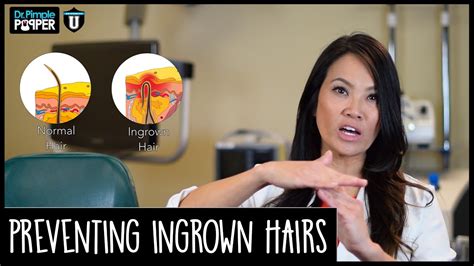 Preventing Ingrown Hairs Pop Quiz Youtube