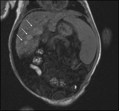 Non Contrast T1 Weighted Abdominal Mri From Dol 68 Showing The