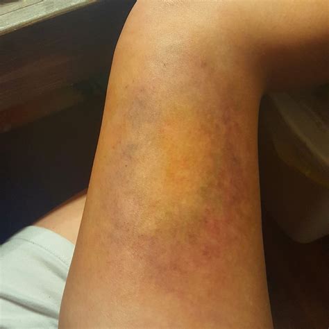 Little Bruises On Legs