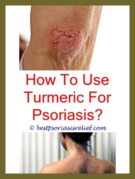Guttate Psoriasis On Face Bisoprolol And Psoriasis Psoriasis On