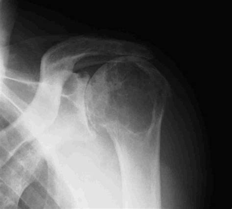 Surgical Treatment Of An Aseptic Fistulized Acromioclavicular Joint